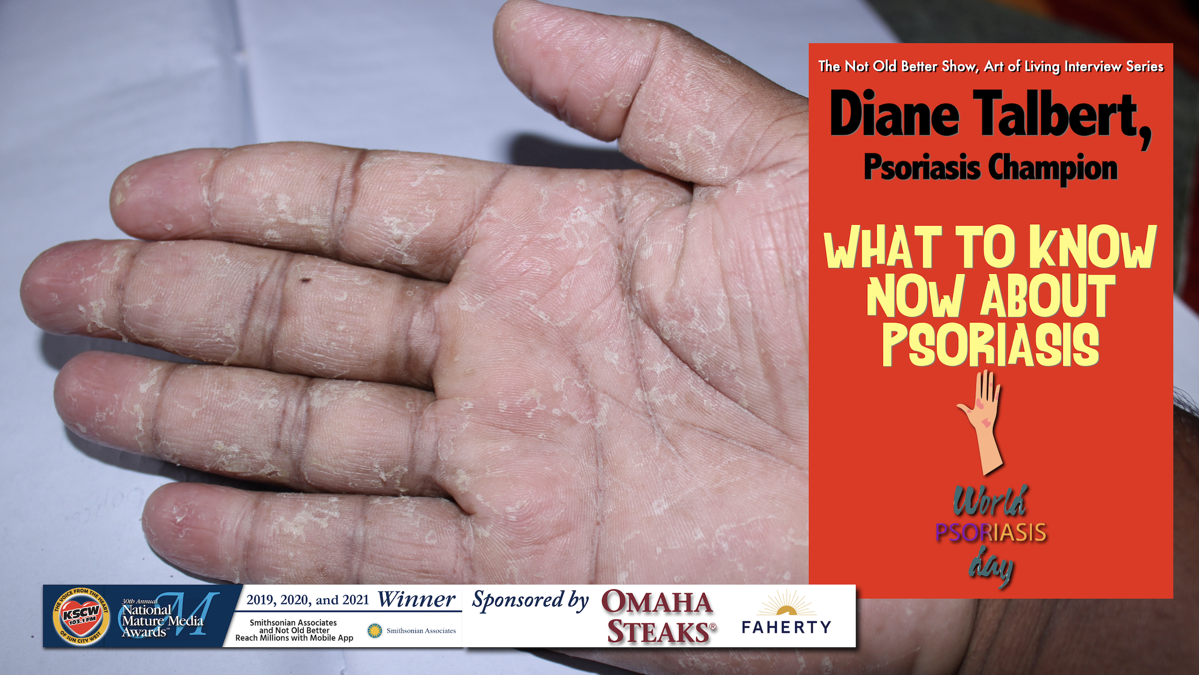 Psoriasis Disease and What You Should Know – Diane Talbert